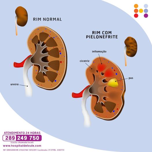 Do you know what pyelonephritis is?