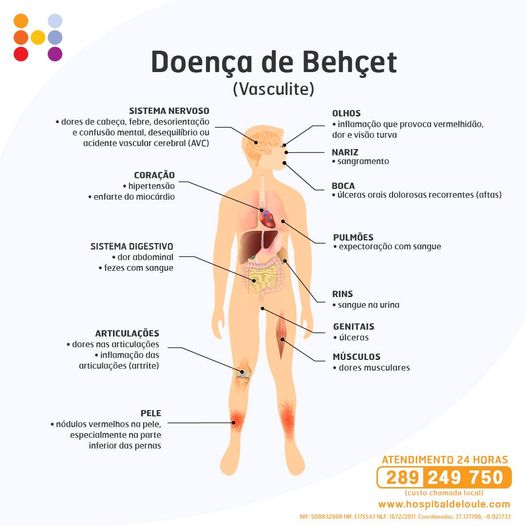 Doença de Behçet