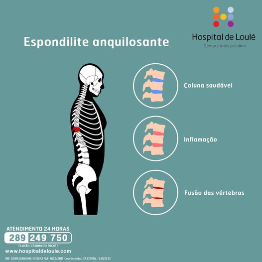 Sabe o que é a espondilite anquilosante?