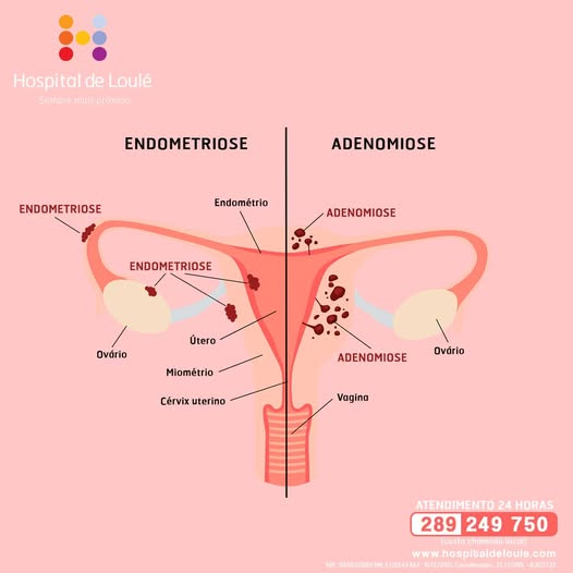 Do you know the difference between endometriosis and adenomyosis?